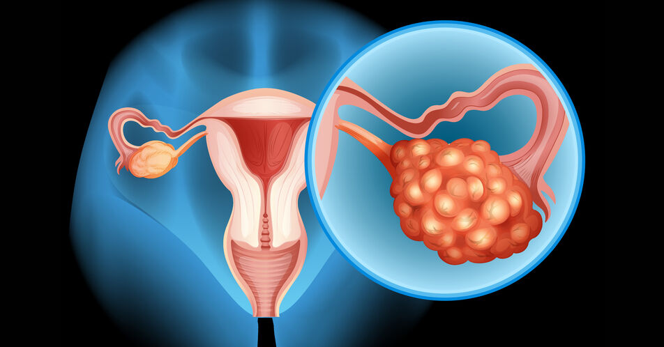 Endometriumkarzinom: Zusatznutzen für Lenvatinib + Pembrolizumab