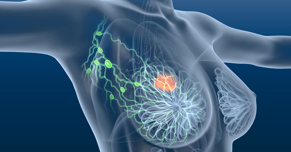Wie entstehen Metastasen bei Brustkrebs?