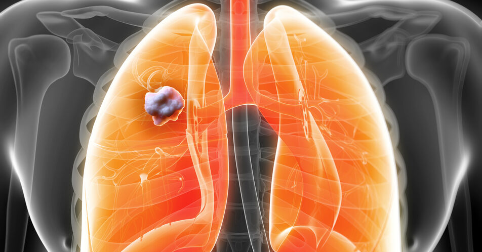 Entzündungsmarker zur Früherkennung von Lungenkarzinomen