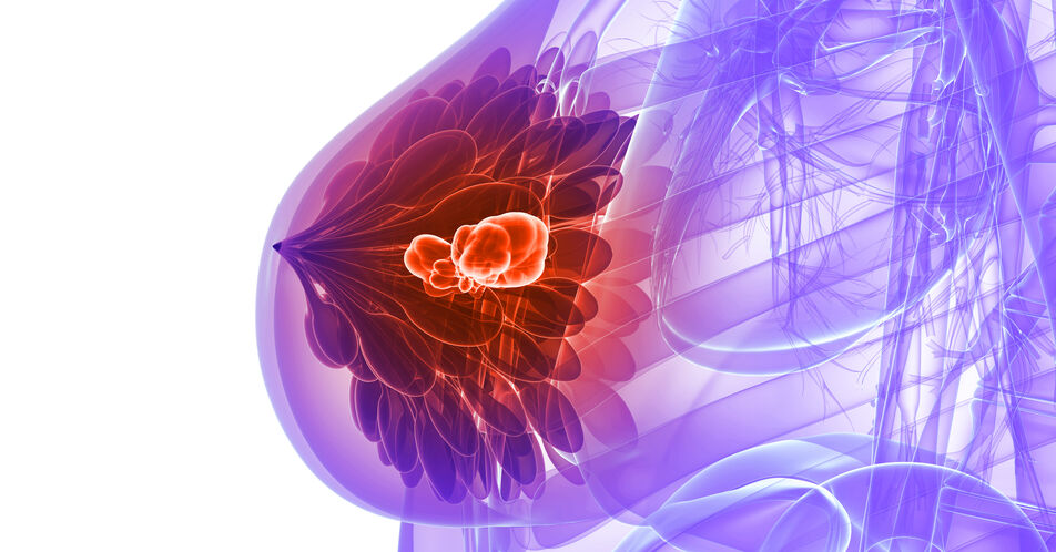 HR+/HER2- fortgeschrittener Brustkrebs: Mit Sacituzumab Govitecan länger progressionsfrei überleben
