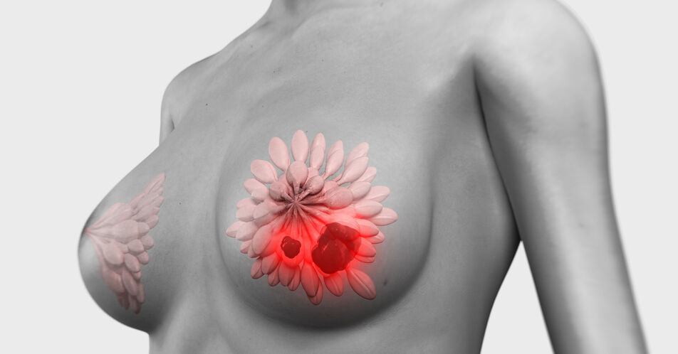 HR+, HER2- fortgeschrittener Brustkrebs: Zweite Zwischenanalyse der MONARCH 3 Studie