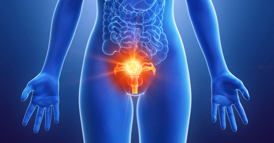 Endometriumkarzinom: Aktualisierte S3-Leitlinie stärkt Bedeutung der molekularen Tumor-Klassifikation und der Immuntherapien