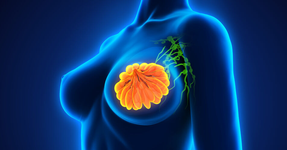 HR+ Brustkrebs: Längeres PFS mit Camizestrant im Vergleich zu Fulvestrant