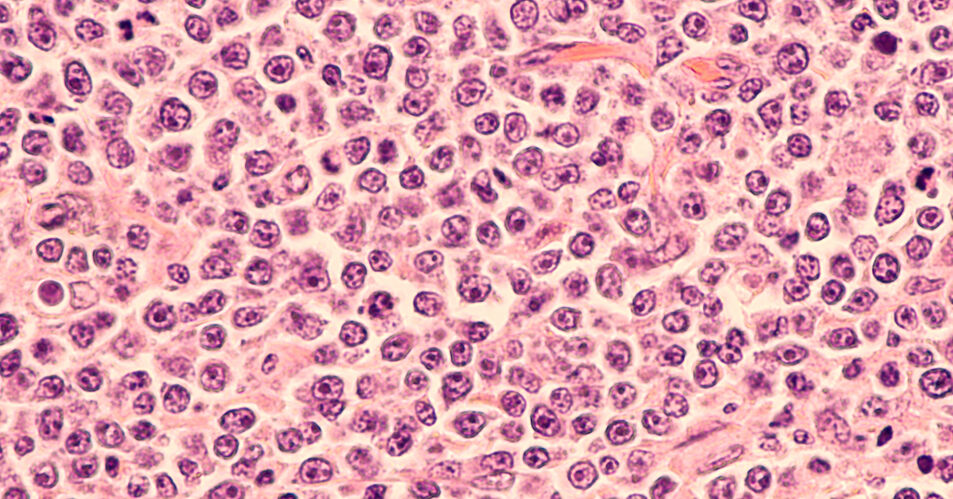Loncastuximab-Tesirin erhält EU-Zulassung für die Behandlung des r/r diffusen großzelligen B-Zell-Lymphoms