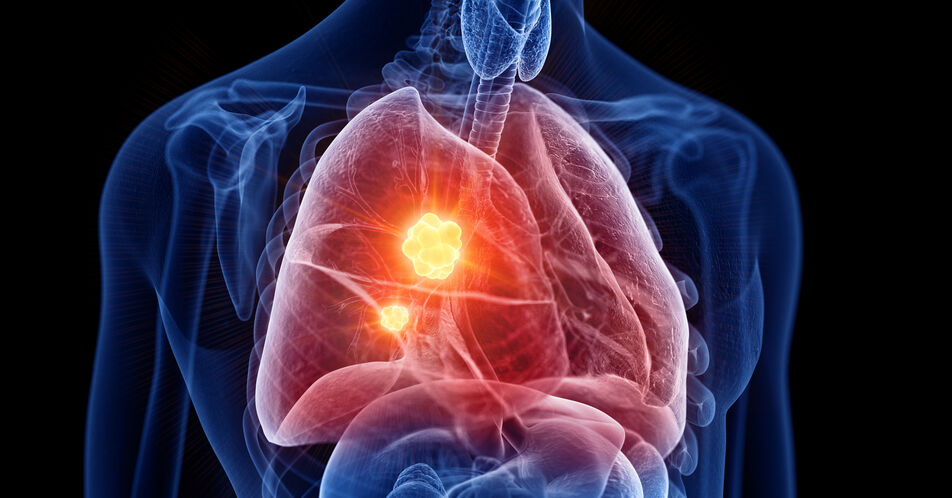 Aktualisierung der Leitlinien zum Lungenkarzinom: Krebsimmuntherapie und molekulare Testung gewinnen an Bedeutung