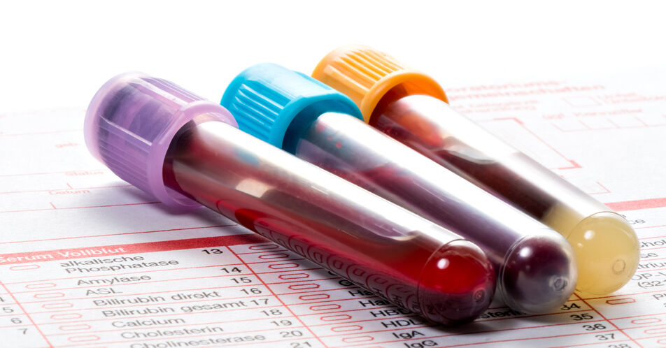 Krebsdiagnose: Bluttest macht Biopsien überflüssig