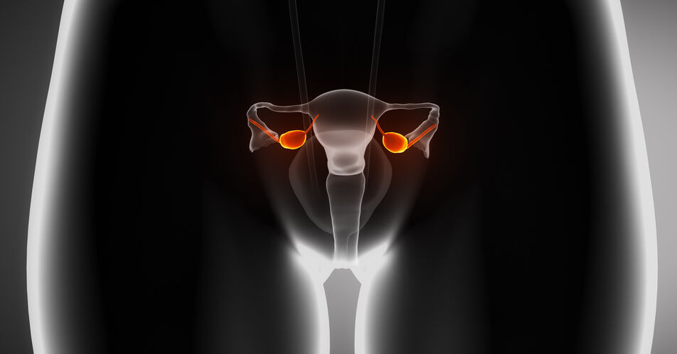 Ovarialkarzinom ohne BRCA1/2-Mutation: Verbesserung des PFS mit Olaparib/Durvalumab-Kombinationstherapie