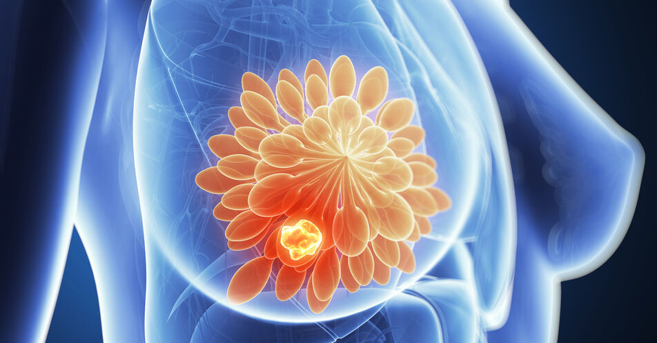 Trastuzumab-Deruxtecan: Vorteile auch bei HER2-low-Brustkrebs