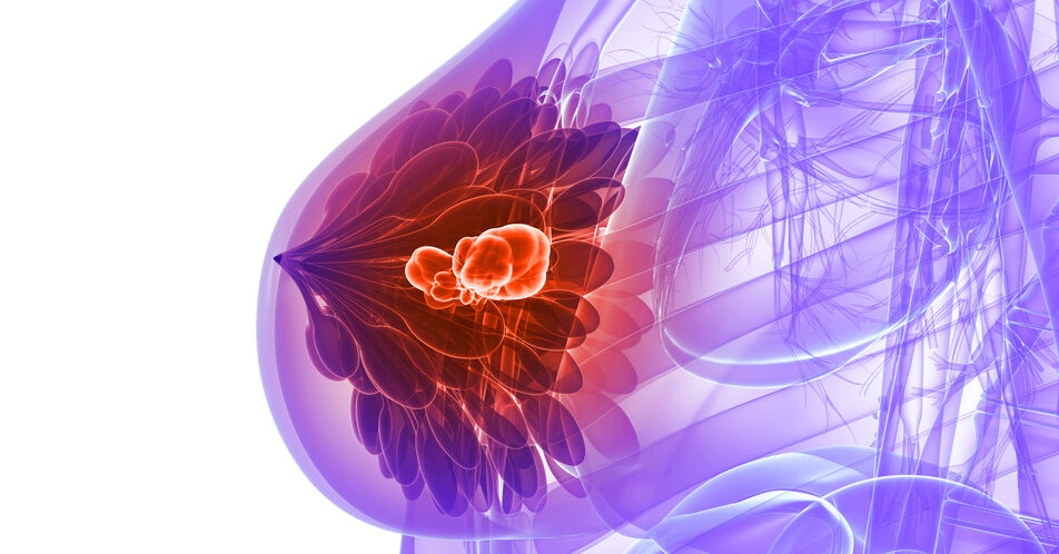 TROPiCS-02: Überlebensvorteil mit Sacituzumab-Govitecan beim HR+/HER2– metastasierten Brustkrebs im längeren Follow-up bestätigt