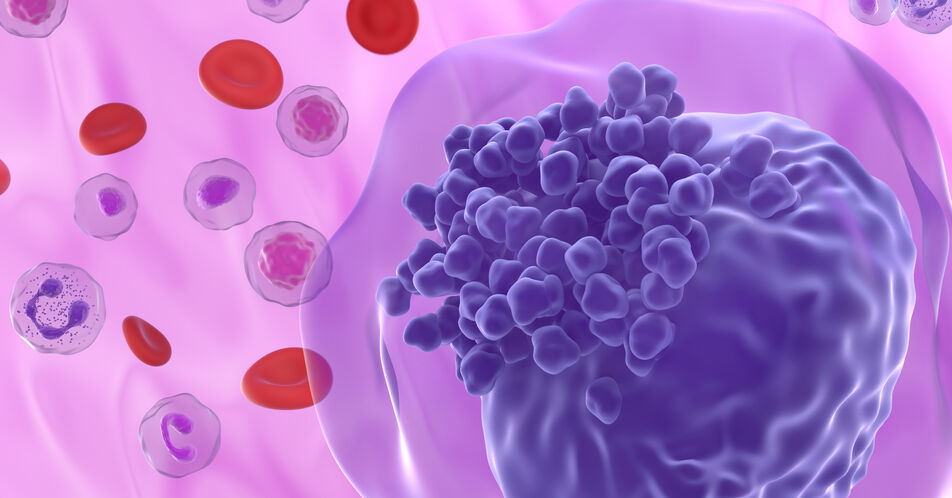 FLT3-ITD AML: Quizartinib + Chemotherapie verlängert das Überleben unabhängig von allo-SCT