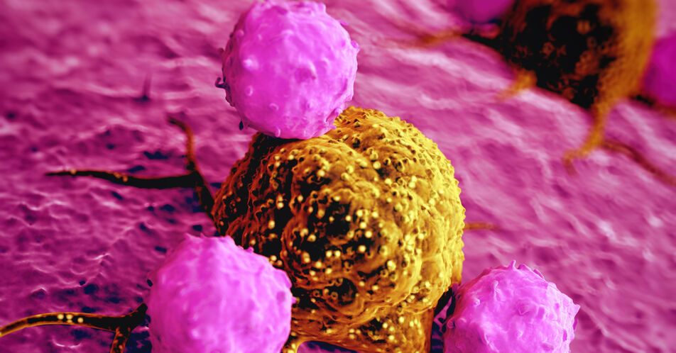 Solide Tumoren: NK-Zellen mit Hydrogel können malignes Gewebe angreifen