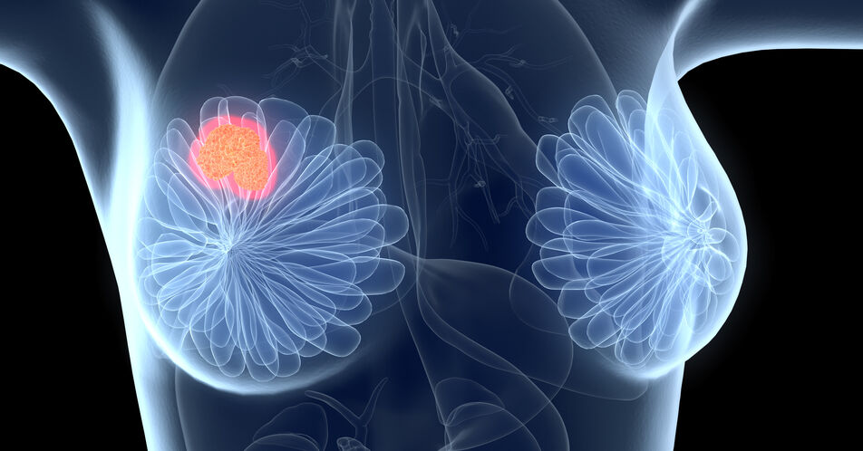 Zulassung für Sacituzumab govitecan bei Brustkrebs erweitert