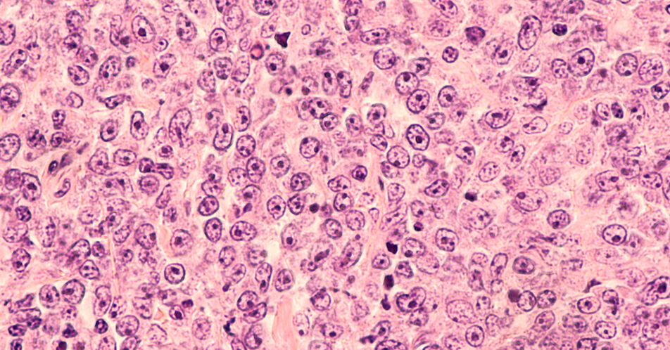 B-Zell-Lymphom: Zweitlinie mit Lisocabtagen maraleucel – Zusatznutzen für bestimmtes Patientenkollektiv