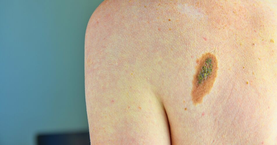 KI erkennt Hautkrebs-Metastasen in Lymphknoten