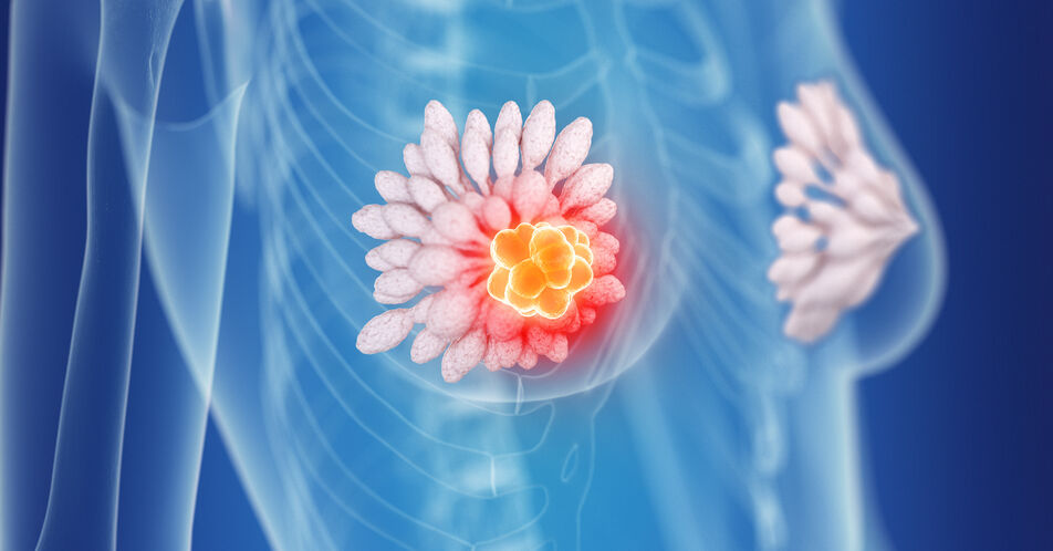NATALEE-Studie: Ribociclib reduziert Rezidivrisiko bei frühem HR+/HER2- Brustkrebs