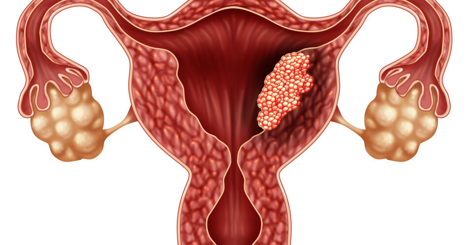 Endometriumkarzinom: Bedeutsame Fortschritte in der Therapie