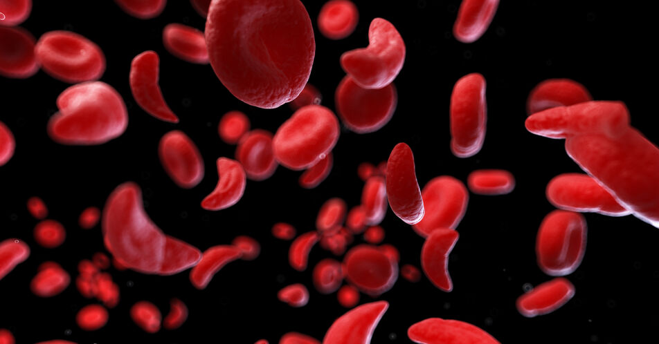 Exa-cel: Geneditierung bietet neue Therapieoptionen bei Hämoglobinopathien