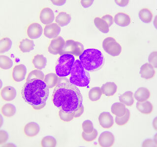 Blutkrebs-Studie: „Mächtige Zwerge“ gegen bösartige Zellen