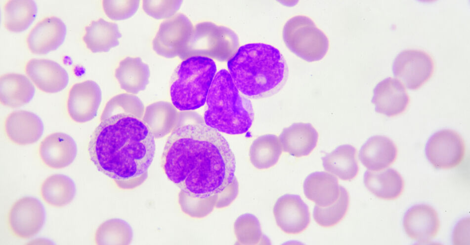 Blutkrebs-Studie: „Mächtige Zwerge“ gegen bösartige Zellen